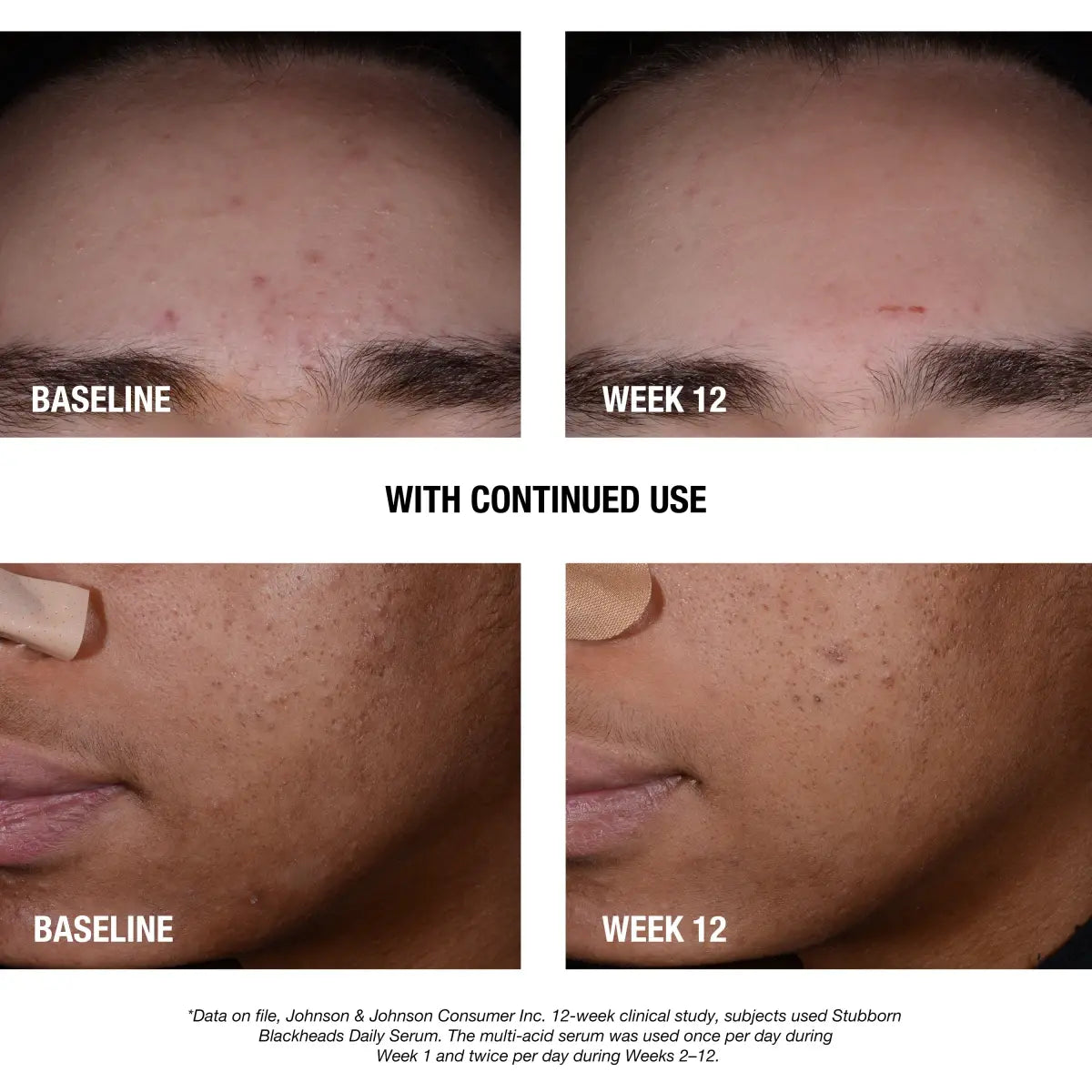 NEUTROGENA BLACKHEADS DAILY SERUM ACNE TREATMENT 30ML